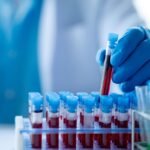 New Blood Test Offers Potential For “Simple, Accurate” ME/CFS Diagnosis, Researchers Claim – Other Experts Aren’t So Sure