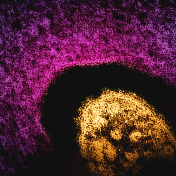 US Breaks New Measles Record, Surpassing 1,500 Cases&hellip;