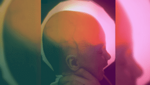 A Woman Born Missing Most Of Her Brain&hellip;