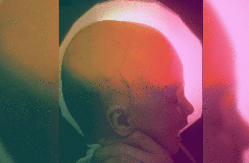 A Woman Born Missing Most Of Her Brain Just Celebrated Her 20th Birthday. What Does That Mean?